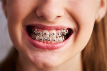 How Orthodontics Can Improve Your Overall Health