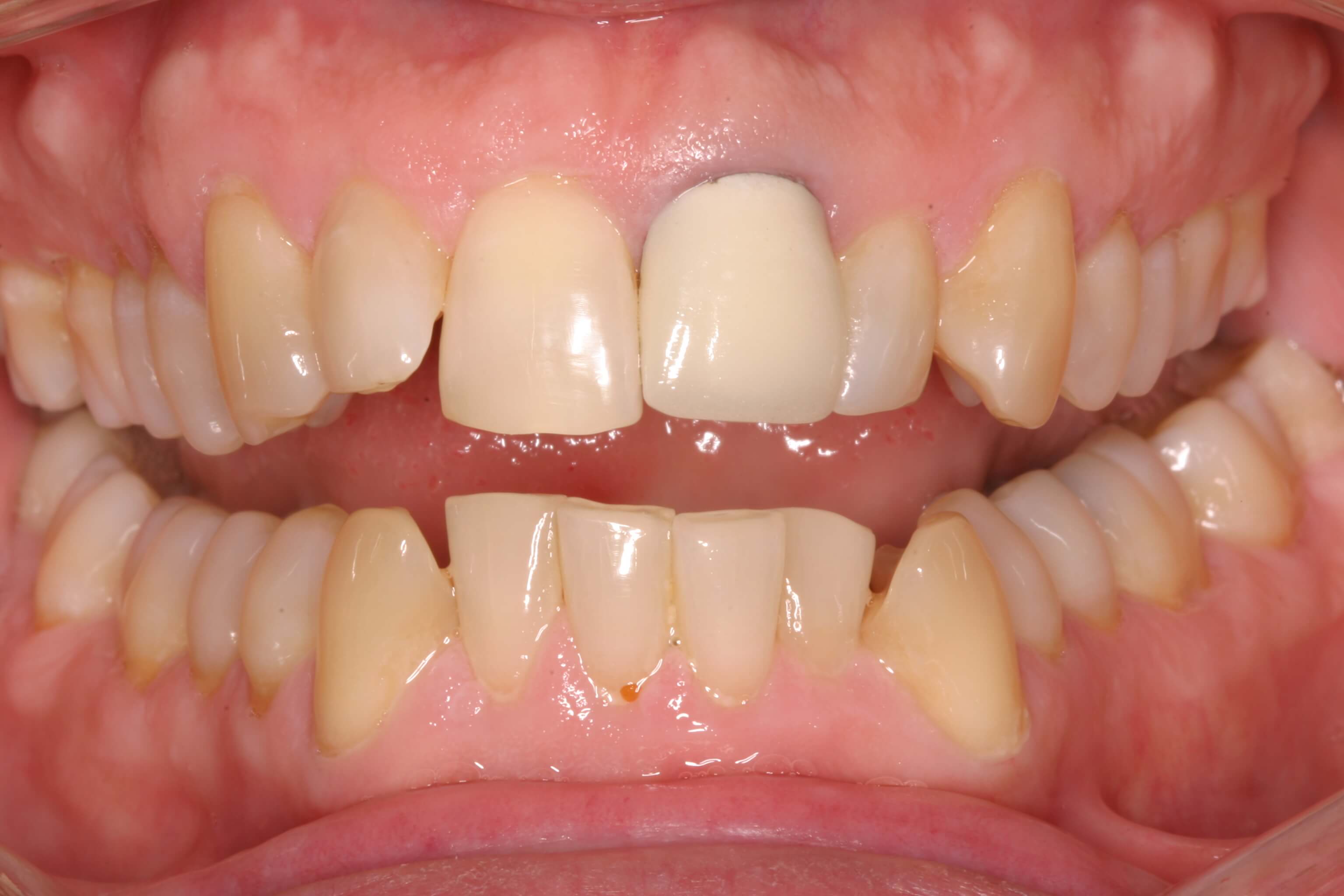 Reasons for tooth discoloration | News | Dentagama