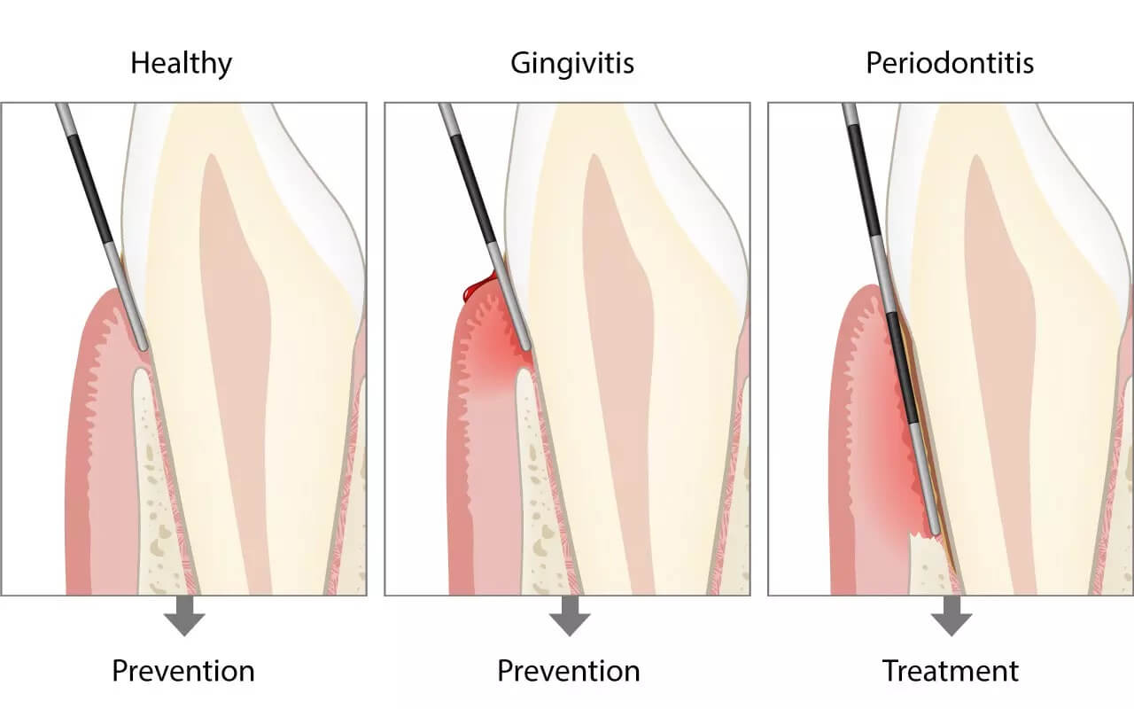 Basic Periodontal Examination BPE News Dentagama