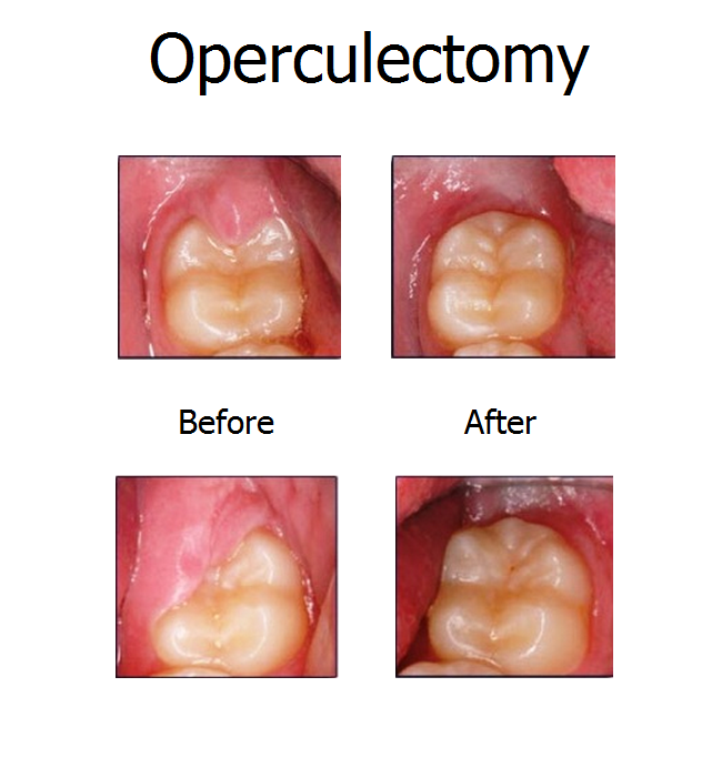 operculectomy