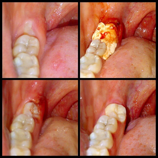 Operculectomy News Dentagama