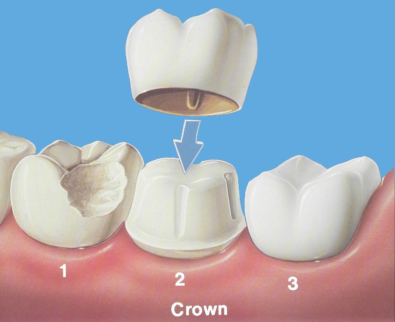 The Different Types Of Dental Crowns Medgaus Dental Care Dentagama