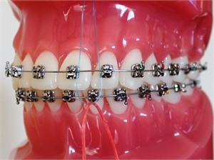 Cleaning braces with floss threader