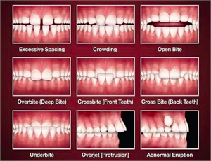 Types of Malocllusion - teeth spacing, crowding, open bite, overbite, crossbite, underbite, overjet and abnormal tooth eruption