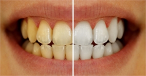 Reasons for tooth discoloration