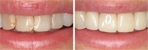White fillings can go dark with age. Replacing them will give your the smile you have always wanted.