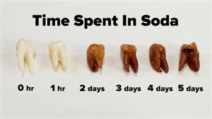 Teeth were dipped in Coca Cola. This is the tooth staining over time.