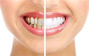Superficial stains on teeth can be caused by excessive consumption of coffee, tea, red wine, dark juices and cigarettes.