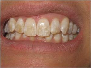 Fluorosis is a condition that causes poor dental tissues quality and tooth darkening that can go from white patches to yellow and dark brown spots.