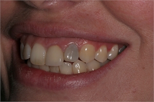 Non vital teeth (teeth that have been root filled) go darker with time.