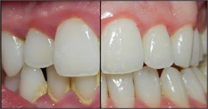 Tartar accumulation around anterior teeth make your teeth look darker.