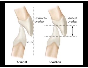 Overjet vs Overbite - horizontal and vertical overlap of the front teeth 