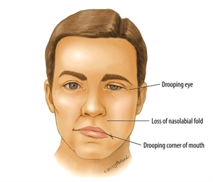 Everything about Bell’s Palsy