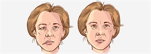 Unilateral facial paralysis may be a condition called Bell's Palsy