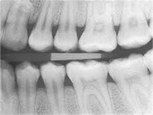 Dental pulp stones visible on x-ray