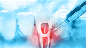 Laser Assisted Endodontic Treatment for Root Canals