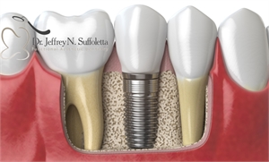 Dental Implant Options