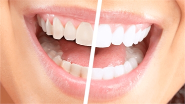 Simple Hacks To Whiten Your Teeth 
