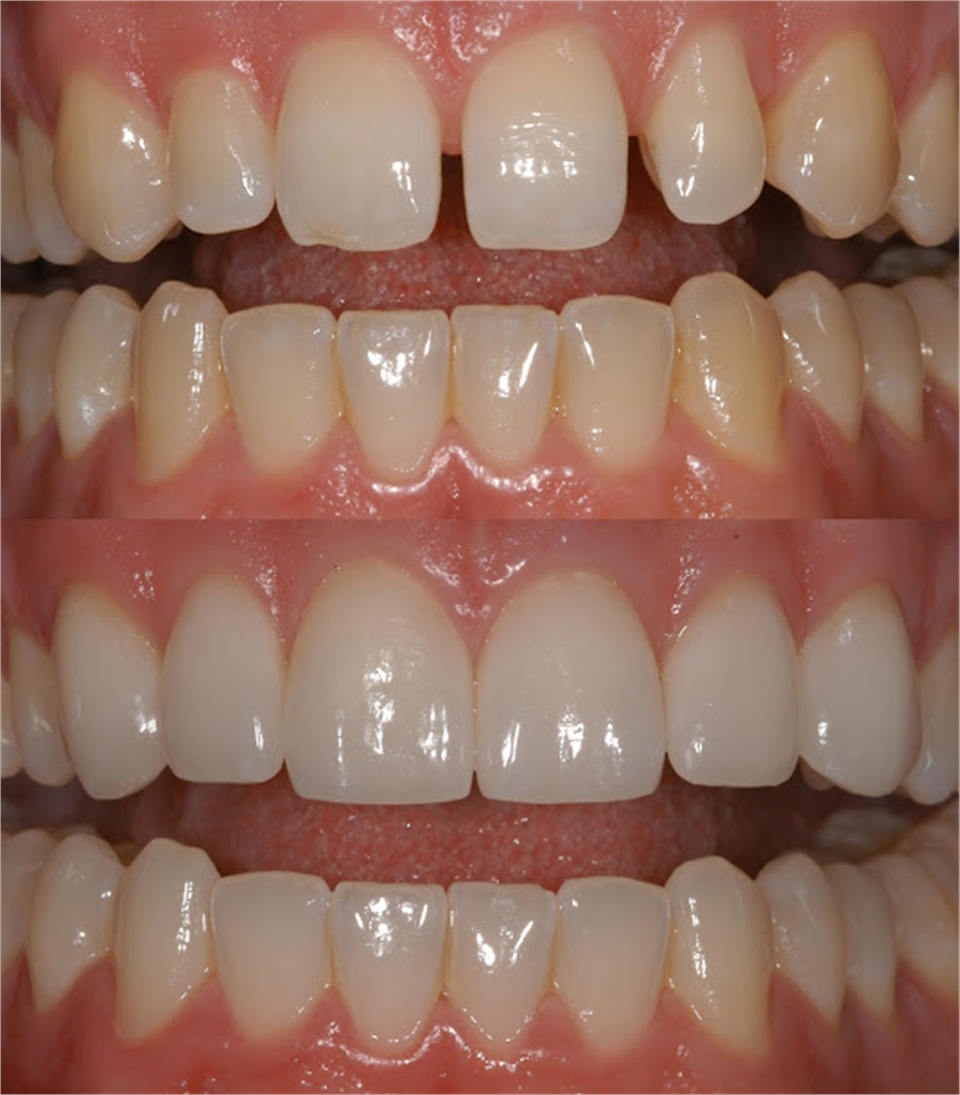Porcelain Veneers Dentagama