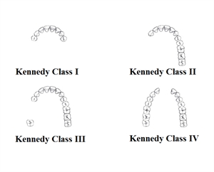 Kennedy Classification