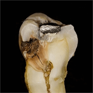 This is how dental decay (tooth caries) looks