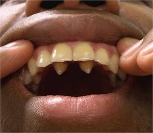 Hyperdontia is the medical term for having extra teeth - supernumerary teeth.