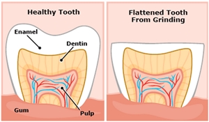 What is bruxism?