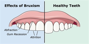Bruxism Effects