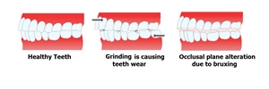 Bruxing is causing teeth wear
