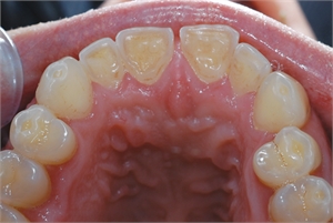 Teeth grinding causes occlusal teeth wear facets.