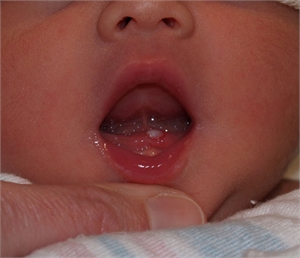Neonatal baby teeth