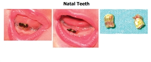 The difference between natal and neonatal teeth