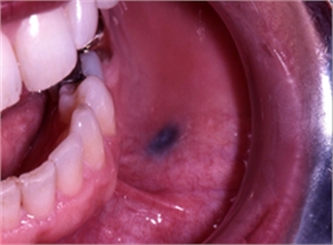 Amalgam Patches on the Mucosa