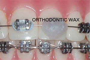 What is orthodontic wax