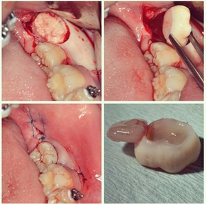 Germectomy is a surgical procedure that removes the wisdom tooth bud at an early stage of tooth and roots development.