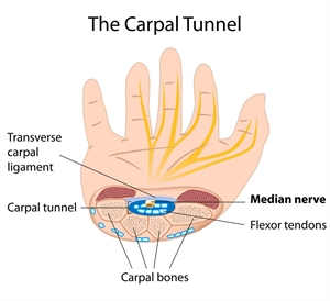 Carpal Tunnel Syndrome CTS is a condition causing chronic pain and numbness of the wrist due to median nerve irritation