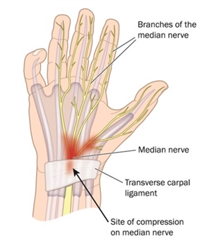 Carpal Tunnel Syndromeis a nerve-related condition caused by compression of the median nerve