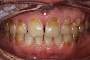 Teeth erosion due to overconsumption of acidic foods and drinks.