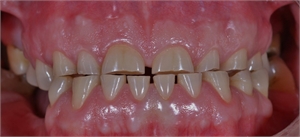 Dental attrition is caused by clenching and bruxing and leads to occlusal teeth wear.