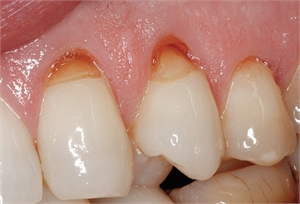 Teeth abrasion is a dental condition that involves enamel loss caused by external forces such as toothbrushes and toothpicks.