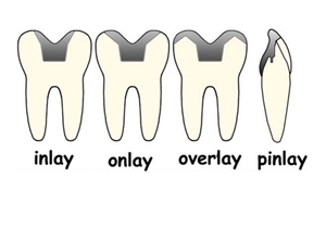 What is the difference between inlay, onlay, overlay and pinlay?