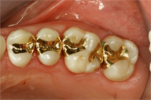 Gold inlays in situ (in the patient mouth)
