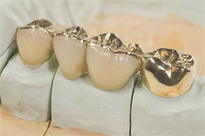 Porcelain fused to gold crowns and a gold overlay