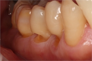 Tooth abfraction appears around the gum line as minuscule wedges or grooves.