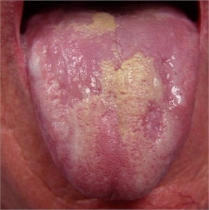 Geographic tongue is characterized by patches with raised borders that look like islands.