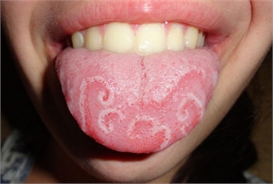 Geographic tongue, also known as benign migratory glossitis, is a harmless condition that impacts the surface of your tongue. 
