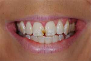 Initial tooth lesions look like white or brown spots on the teeth and are caused by demineralized enamel.