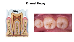 Enamel decay, also known as a superficial cavity, is an infected enamel structure on the teeth surface.