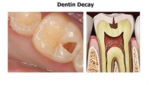 When the caries progresses into dentin we have a deep cavity, also known as dentin decay.