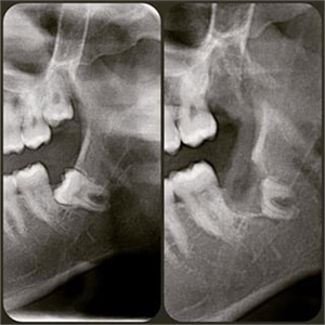 Xray of coronectomy - before and after